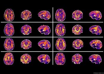 Estudio reveló que la desigualdad social altera el cerebro de los niños: «Tiene un impacto duradero»
