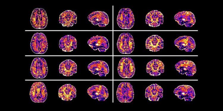 Estudio reveló que la desigualdad social altera el cerebro de los niños: «Tiene un impacto duradero»